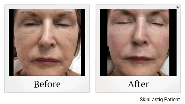 Juvederm results for cheek volume at Skinlastiq Medical Laser Cosmetic Spa in Burlingame