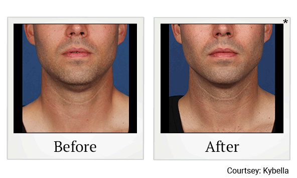 Kybella results for double chin reduction at Skinlastiq Medical Laser Cosmetic Spa in Burlingame