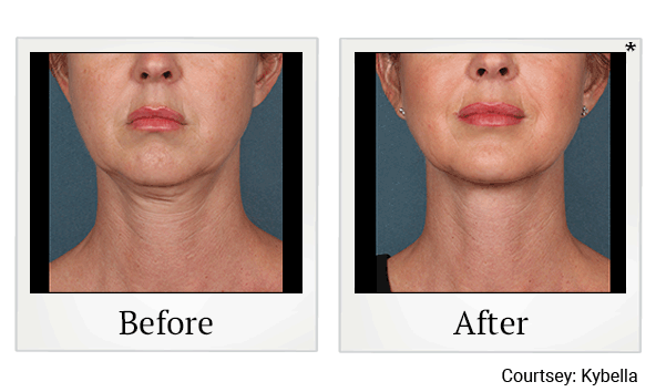 Kybella results for double chin reduction at Skinlastiq Medical Laser Cosmetic Spa in Burlingame