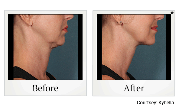 Kybella results for double chin reduction at Skinlastiq Medical Laser Cosmetic Spa in Burlingame