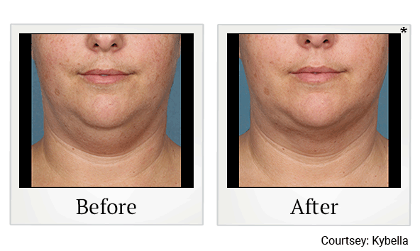 kybella before and after at Skinlastiq Medical Laser Cosmetic Spa in Burlingame