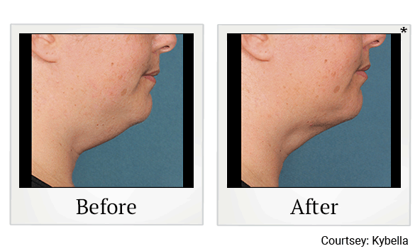 kybella before and after at Skinlastiq Medical Laser Cosmetic Spa in Burlingame