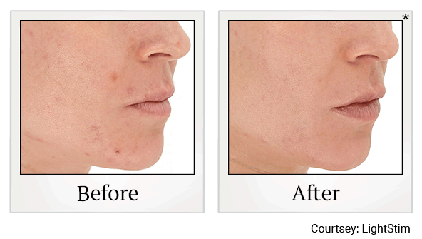 lightstim before and after at Skinlastiq Medical Laser Cosmetic Spa in Burlingame