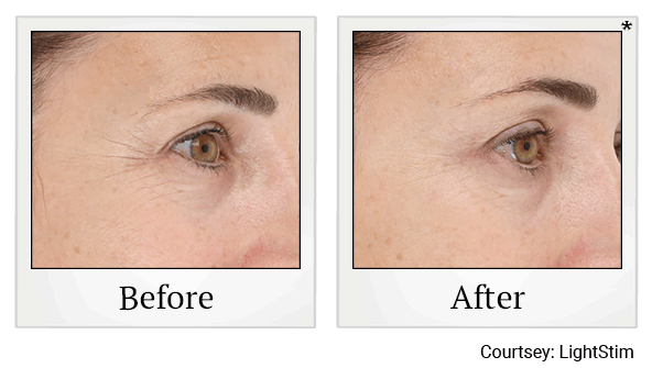 LED Light Therapy results for wrinkles at Skinlastiq Medical Laser Cosmetic Spa in Burlingame