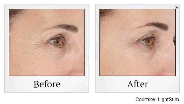 lightstim before and after at Skinlastiq Medical Laser Cosmetic Spa in Burlingame