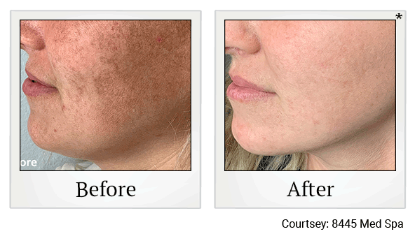 Lumecca IPL Treatments results for hyperpigmentation at Skinlastiq Medical Laser Cosmetic Spa in Burlingame