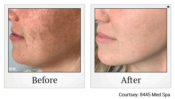 lumecca before and after at Skinlastiq Medical Laser Cosmetic Spa in Burlingame