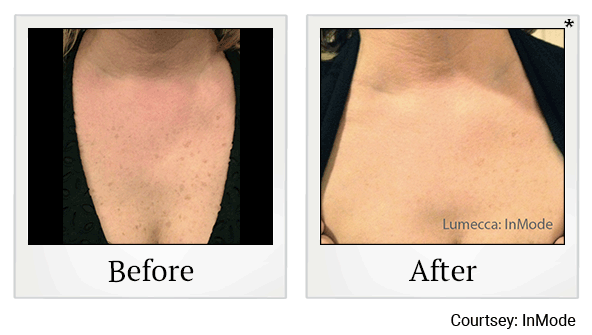 lumecca before and after at Skinlastiq Medical Laser Cosmetic Spa in Burlingame