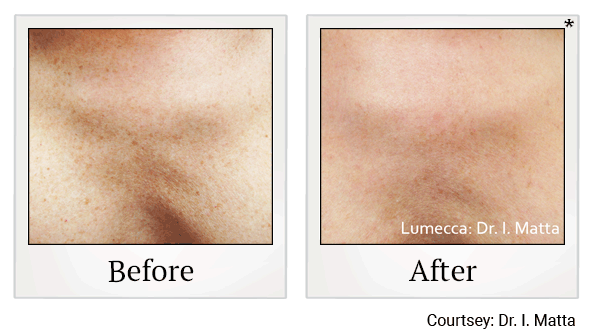 lumecca before and after at Skinlastiq Medical Laser Cosmetic Spa in Burlingame