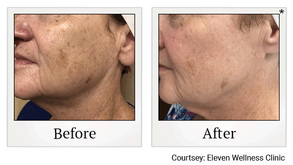 lumecca before and after at Skinlastiq Medical Laser Cosmetic Spa in Burlingame