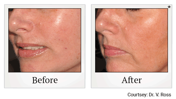 lumecca before and after at Skinlastiq Medical Laser Cosmetic Spa in Burlingame