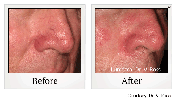 lumecca before and after at Skinlastiq Medical Laser Cosmetic Spa in Burlingame