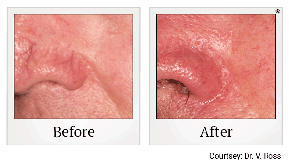 lumecca before and after at Skinlastiq Medical Laser Cosmetic Spa in Burlingame