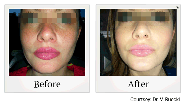 lumecca before and after at Skinlastiq Medical Laser Cosmetic Spa in Burlingame