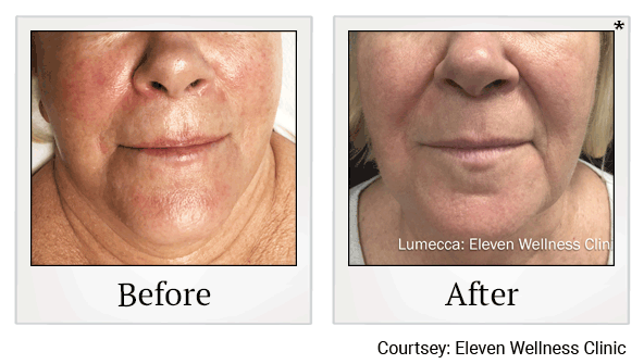 lumecca before and after at Skinlastiq Medical Laser Cosmetic Spa in Burlingame