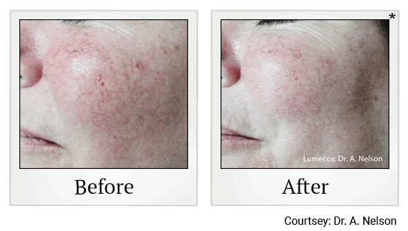 lumecca before and after at Skinlastiq Medical Laser Cosmetic Spa in Burlingame