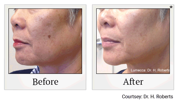 Lumecca IPL Treatments results for sun damage at Skinlastiq Medical Laser Cosmetic Spa in Burlingame