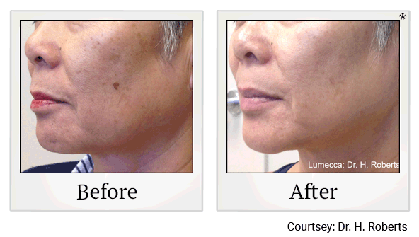 lumecca before and after at Skinlastiq Medical Laser Cosmetic Spa in Burlingame