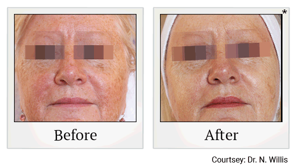 lumecca before and after at Skinlastiq Medical Laser Cosmetic Spa in Burlingame