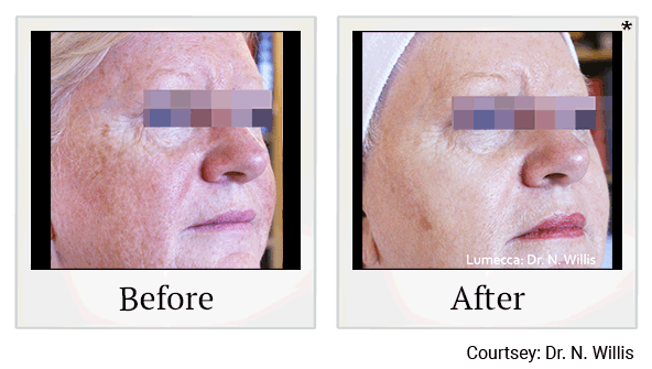 lumecca before and after at Skinlastiq Medical Laser Cosmetic Spa in Burlingame