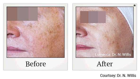 lumecca before and after at Skinlastiq Medical Laser Cosmetic Spa in Burlingame