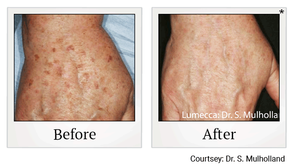 lumecca before and after at Skinlastiq Medical Laser Cosmetic Spa in Burlingame