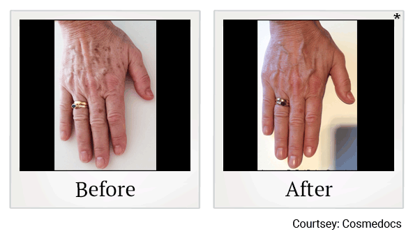 lumecca before and after at Skinlastiq Medical Laser Cosmetic Spa in Burlingame