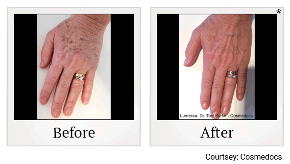 lumecca before and after at Skinlastiq Medical Laser Cosmetic Spa in Burlingame