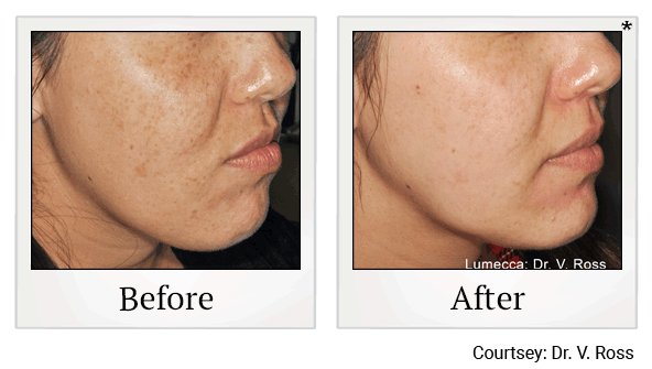 lumecca before and after at Skinlastiq Medical Laser Cosmetic Spa in Burlingame