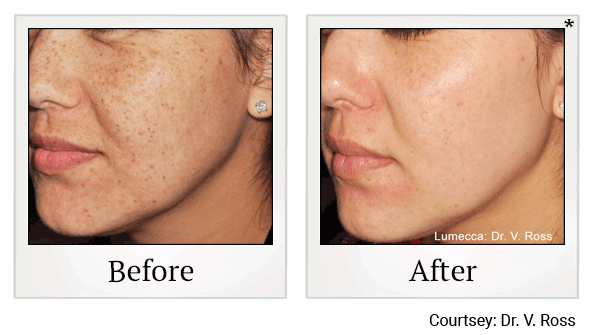 lumecca before and after at Skinlastiq Medical Laser Cosmetic Spa in Burlingame