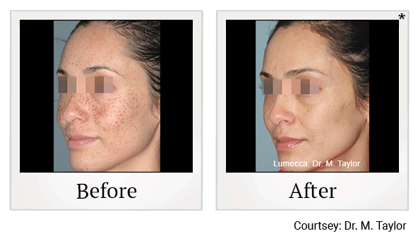 lumecca before and after at Skinlastiq Medical Laser Cosmetic Spa in Burlingame