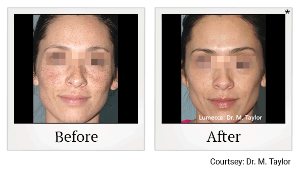 lumecca before and after at Skinlastiq Medical Laser Cosmetic Spa in Burlingame