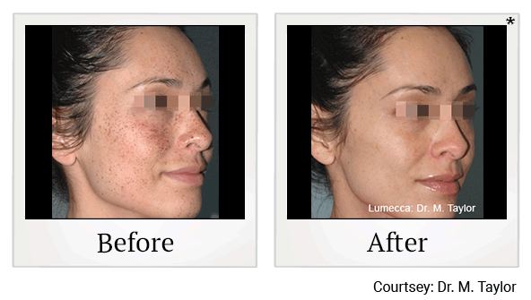 lumecca before and after at Skinlastiq Medical Laser Cosmetic Spa in Burlingame