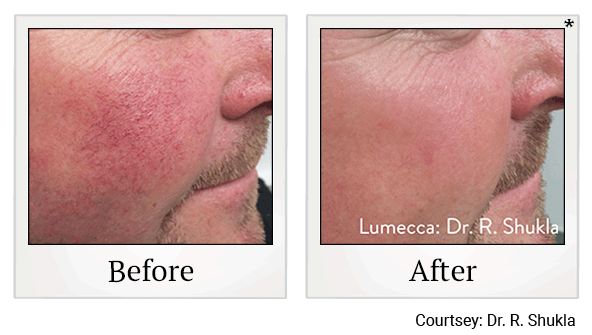 Lumecca IPL Treatments results for rosacea at Skinlastiq Medical Laser Cosmetic Spa in Burlingame