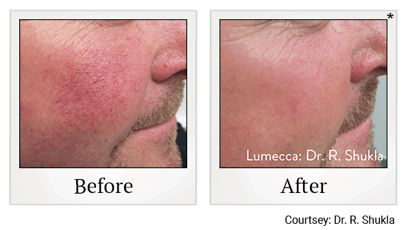 lumecca before and after at Skinlastiq Medical Laser Cosmetic Spa in Burlingame