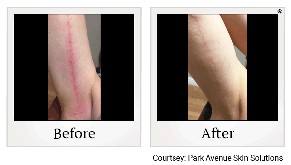 Lumecca IPL Treatments results for scarring at Skinlastiq Medical Laser Cosmetic Spa in Burlingame