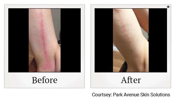 lumecca before and after at Skinlastiq Medical Laser Cosmetic Spa in Burlingame