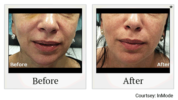 morpheus8 before and after at Skinlastiq Medical Laser Cosmetic Spa in Burlingame