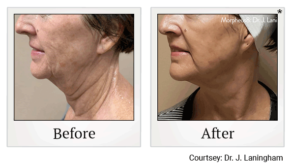 morpheus8 before and after at Skinlastiq Medical Laser Cosmetic Spa in Burlingame