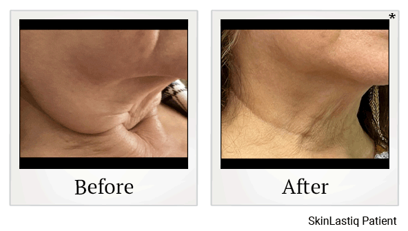 Morpheus8 RF Microneedling results for skin tightening at Skinlastiq Medical Laser Cosmetic Spa in Burlingame
