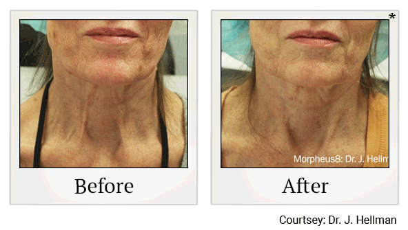 Morpheus8 RF Microneedling results for turkey neck at Skinlastiq Medical Laser Cosmetic Spa in Burlingame