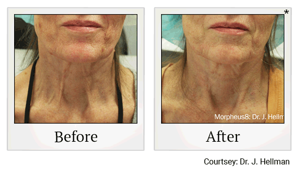 morpheus8 before and after at Skinlastiq Medical Laser Cosmetic Spa in Burlingame