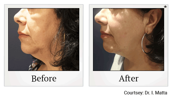 Morpheus8 RF Microneedling results for double chin at Skinlastiq Medical Laser Cosmetic Spa in Burlingame