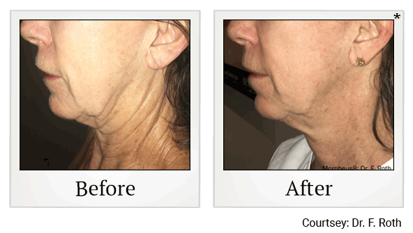 morpheus8 before and after at Skinlastiq Medical Laser Cosmetic Spa in Burlingame