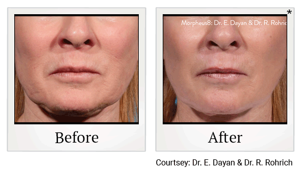 morpheus8 before and after at Skinlastiq Medical Laser Cosmetic Spa in Burlingame