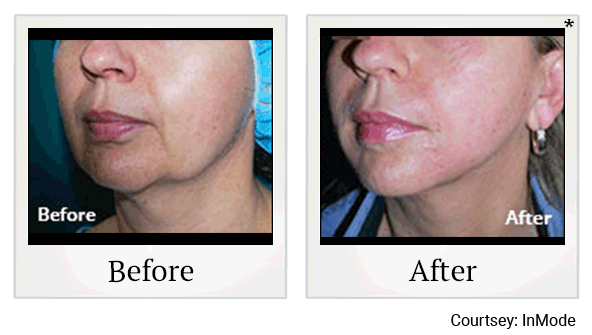 Morpheus8 RF Microneedling results for jowls at Skinlastiq Medical Laser Cosmetic Spa in Burlingame