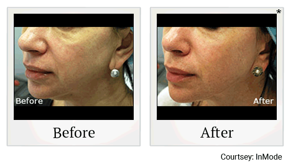 morpheus8 before and after at Skinlastiq Medical Laser Cosmetic Spa in Burlingame