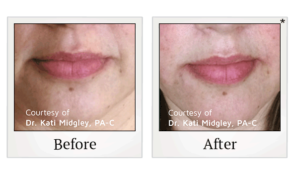 PDO Thread Facelift results for saggy skin at Skinlastiq Medical Laser Cosmetic Spa in Burlingame