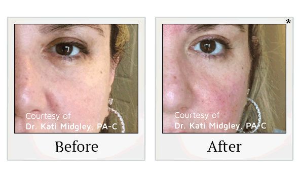 PDO Thread Facelift results for saggy skin at Skinlastiq Medical Laser Cosmetic Spa in Burlingame