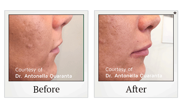 PDO Thread Facelift results for saggy skin at Skinlastiq Medical Laser Cosmetic Spa in Burlingame